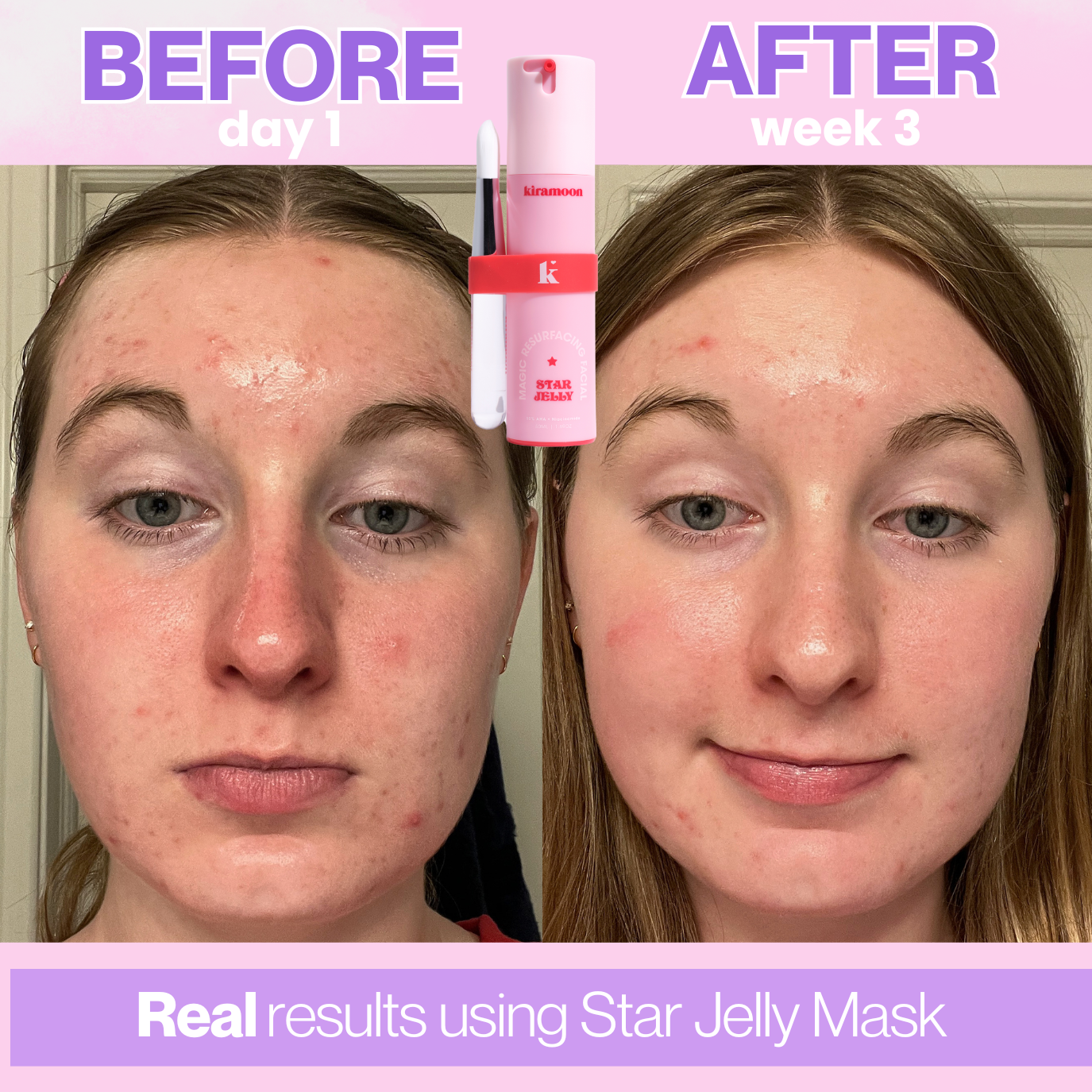 Kiramoon - Star Jelly 10% AHA Resurfacing Facial Mask