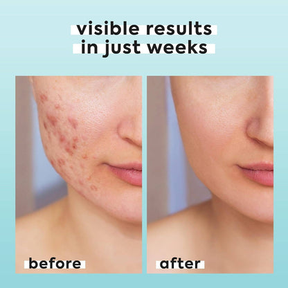 Livaclean - Livaclean 3.4oz Hypochlorous Acid Mist for face &amp; body