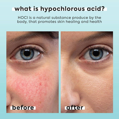 Livaclean - Livaclean 3.4oz Hypochlorous Acid Mist for face &amp; body